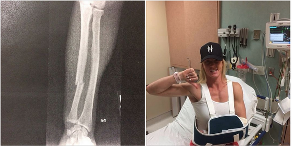 Holly Holm arm update: Bone plated, perfectly aligned