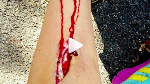 Bec Rawlings sustains nasty leg injury, calls it 'shin vagina'