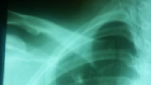 Angela Magana x-ray shows broken bone, shots fired at Aldo