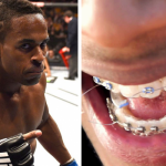 Lorenz Larkin teeth