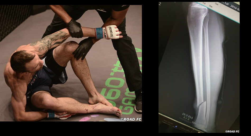 George Roop breaks leg at Road FC 31