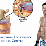 Chris Weidman will undergo surgery on herniated discs on Wednesday at Columbia University Medical Center