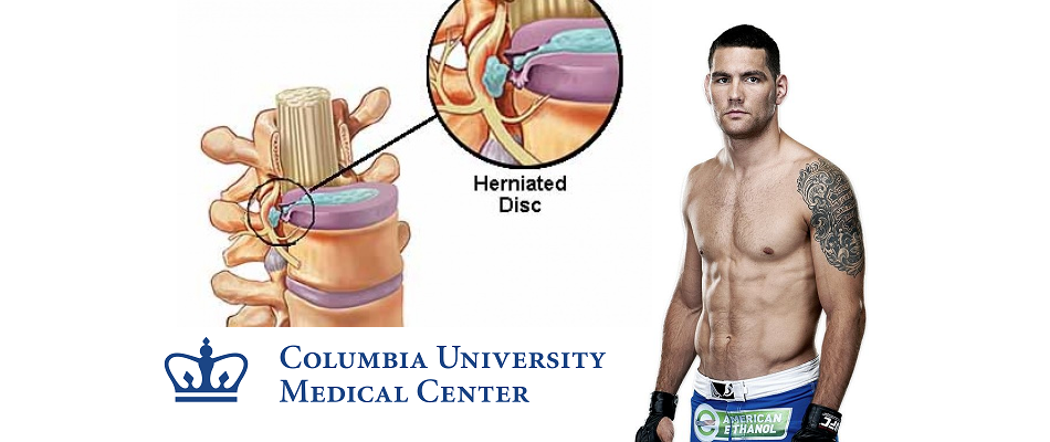 Chris Weidman will undergo surgery on herniated discs on Wednesday at Columbia University Medical Center