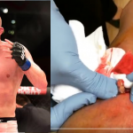 Patrick Cummins out of UFC Albany with nasty staph infection