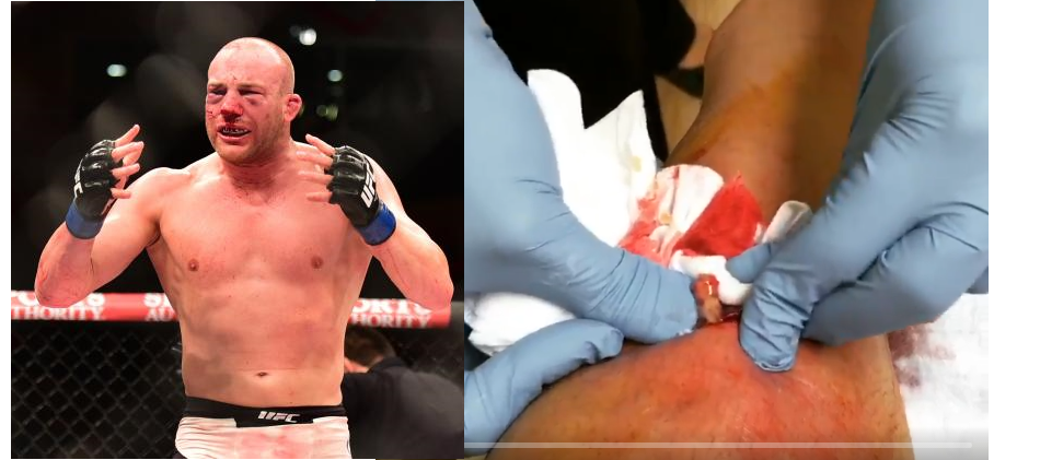 Patrick Cummins out of UFC Albany with nasty staph infection