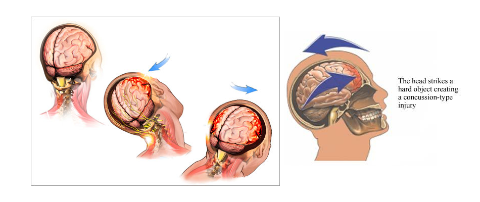 From The Coach's Corner: This Is Your Brain On MMA