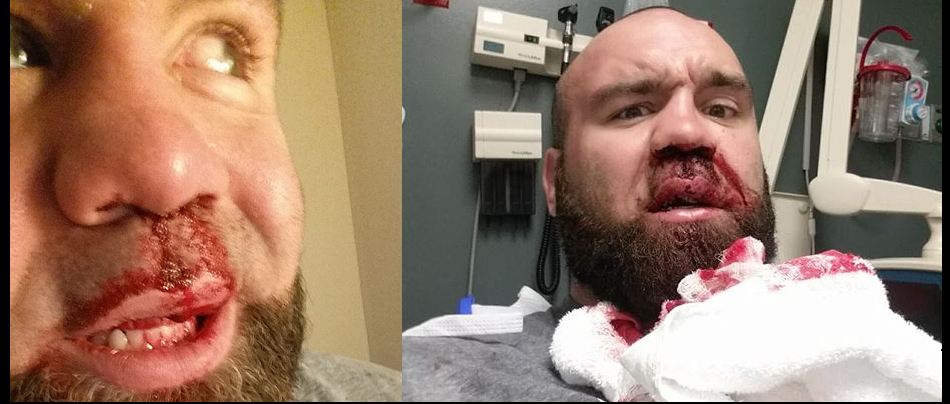 Bumps, bruises, and broken noses - Victory FC heavyweight champ Daniel Gallemore