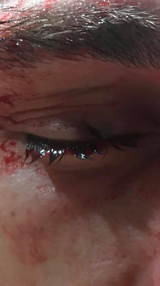 Johnny Case eye injury