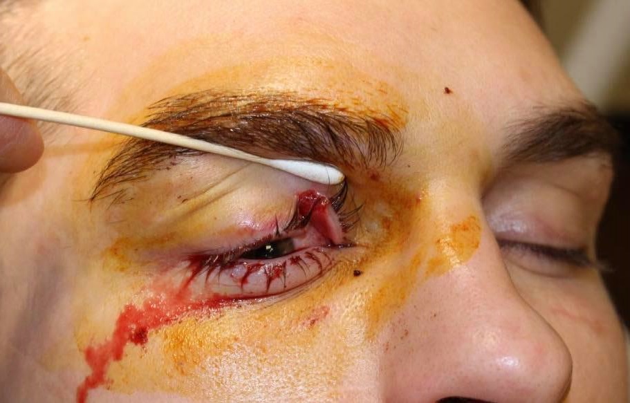 Johnny Case eye injury