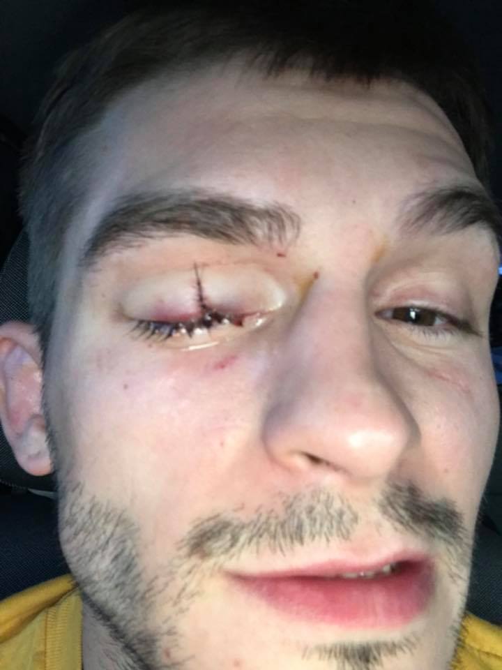 Johnny Case eye injury