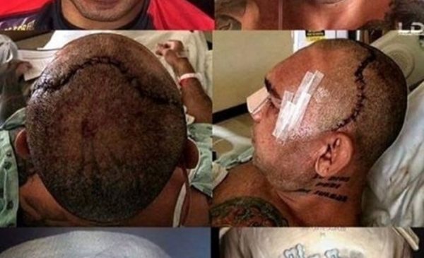 Evangelista Santos skull injury - MyMMANews.com