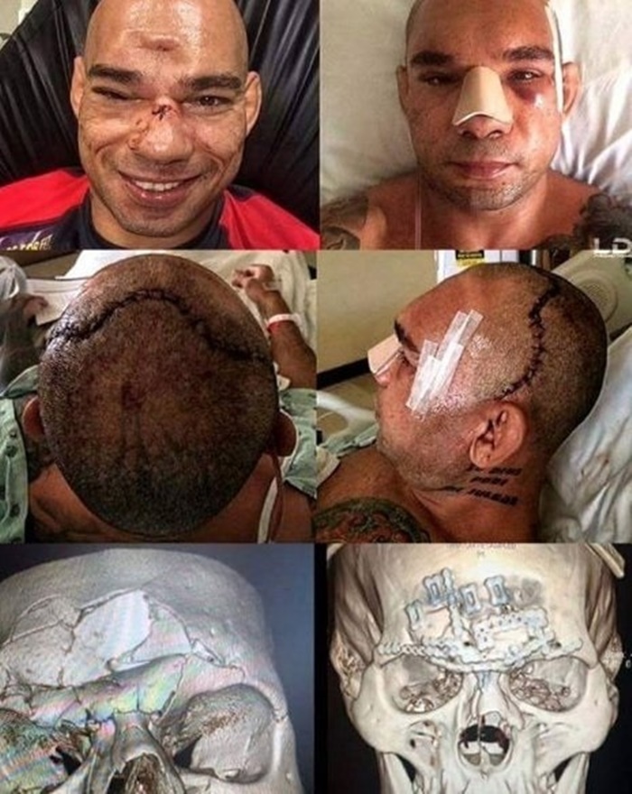 Evangelista Santos skull injury