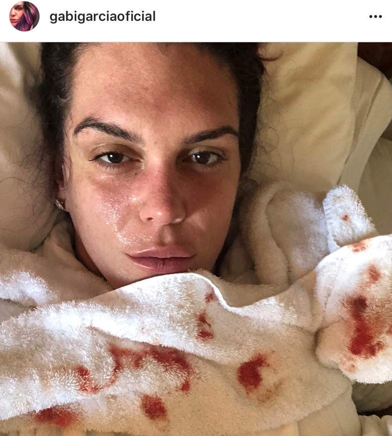 Gabi Garcia nose bleed