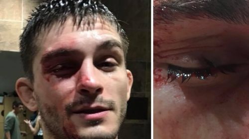 UFC lightweight Johnny Case sustains gruesome injury in training