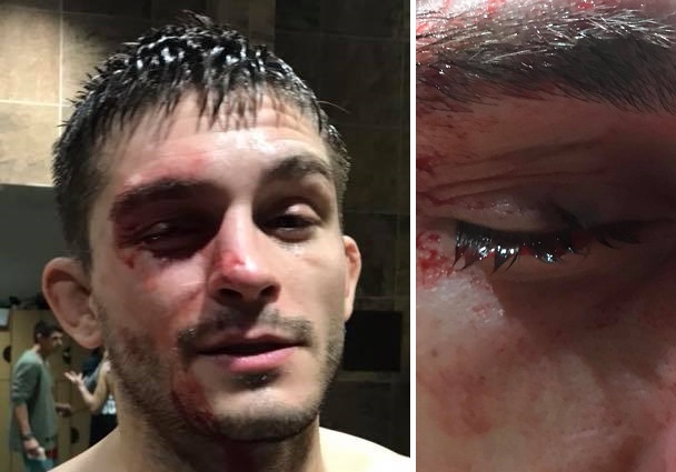UFC lightweight Johnny Case sustains gruesome injury in training