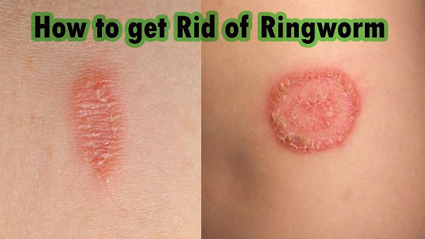 What is ringworm