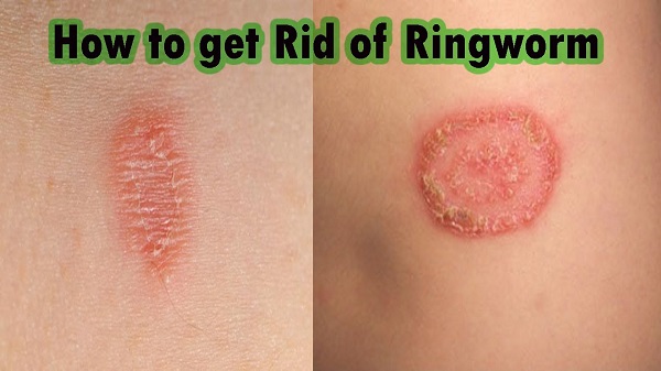 Should I Stay Off Work With Ringworm