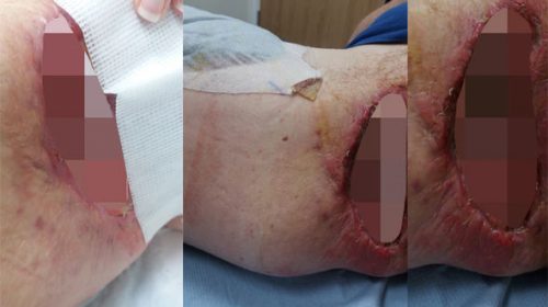 Keeping Skin Diseases At Bay As An MMA Fighter