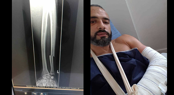 Tahar Hadbi sustained serious arm injury during Brave 12