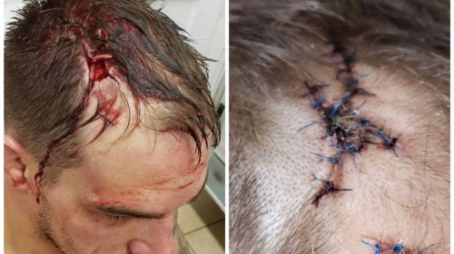 Adam Townsend reveals the horrifying cut from Brave 19