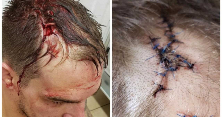 Adam Townsend reveals the horrifying cut from Brave 19