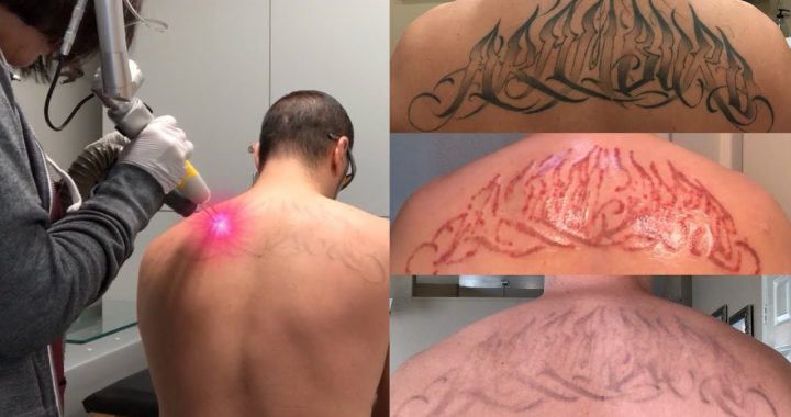 How long does it take laser tattoo removal to heal before I can fight?