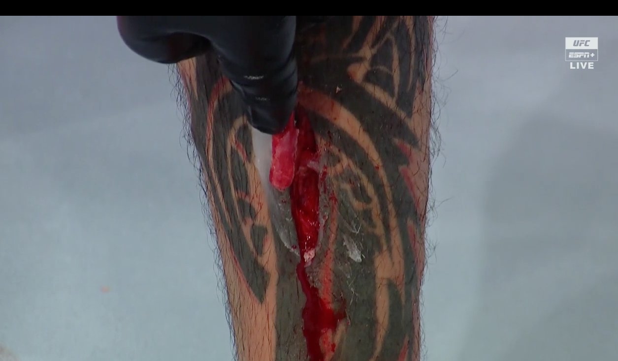 Gabriel Benitez, hole in leg