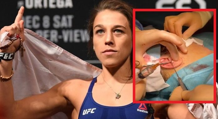 Joanna Jedrzejczyk shares gruesome video of cauliflower ear surgery