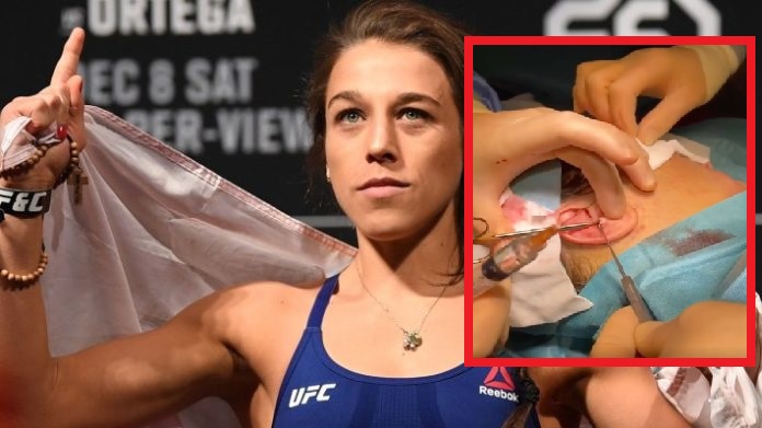 Joanna Jedrzejczyk shares gruesome video of cauliflower ear surgery