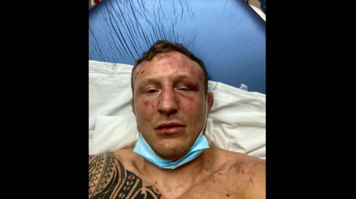 Jack Hermansson breaks eye socket and toe in loss to Marvin Vettori