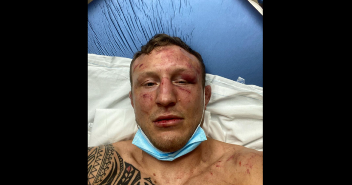 Jack Hermansson breaks eye socket and toe in loss to Marvin Vettori