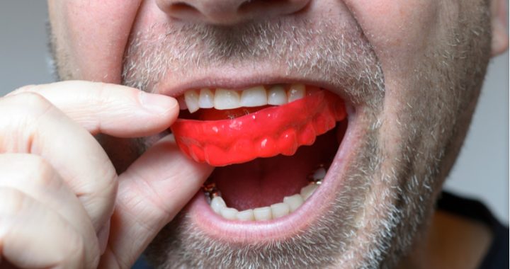 dental tips, mouthguard