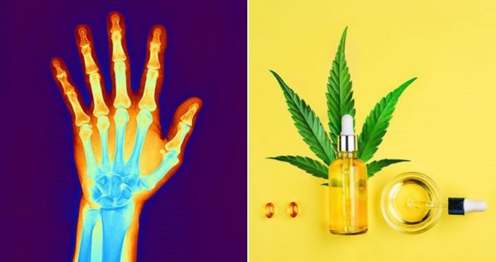 cbd, arthritis