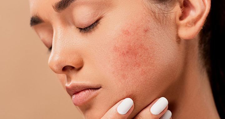 Can CBD treat Acne?