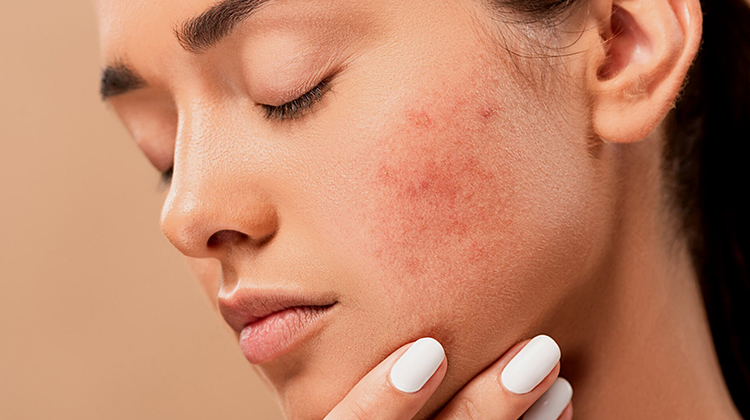 Can CBD treat Acne?