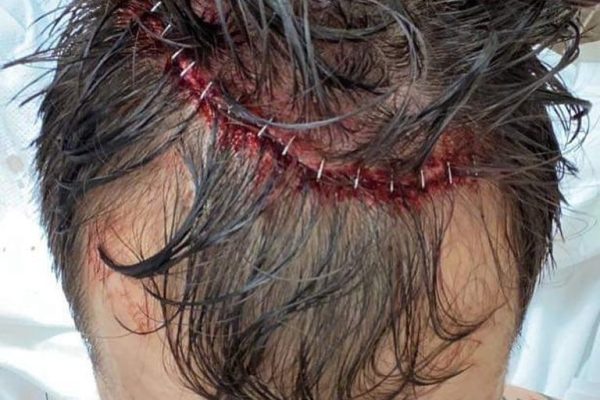 Staples in Hunter Boone's head