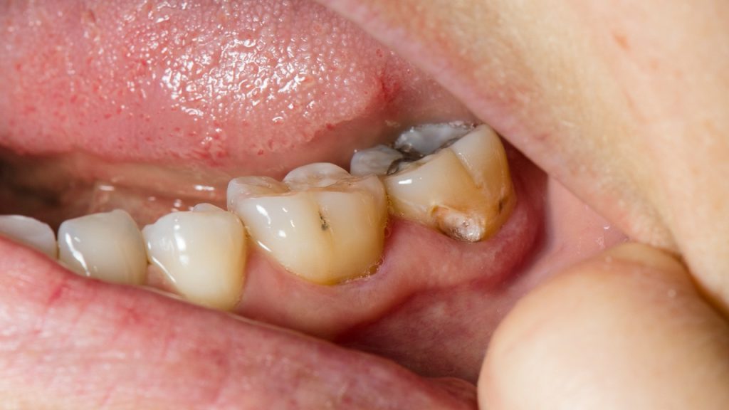 tooth damage