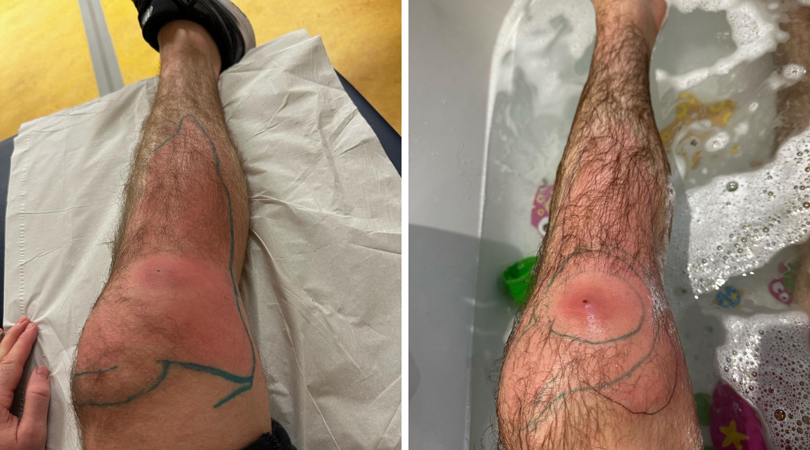 Ingrown hair likely cause of MRSA for PFL fighter Steven Ray - Vimarsana News