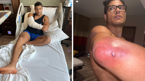 Paulo Costa, elbow surgery, UFC 294