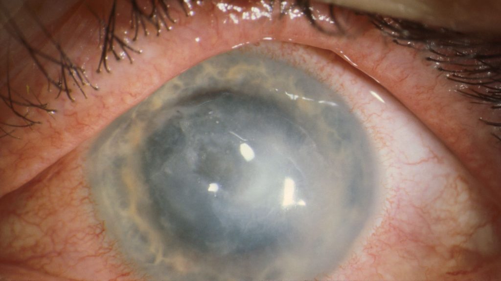 contact lenses, eye infections