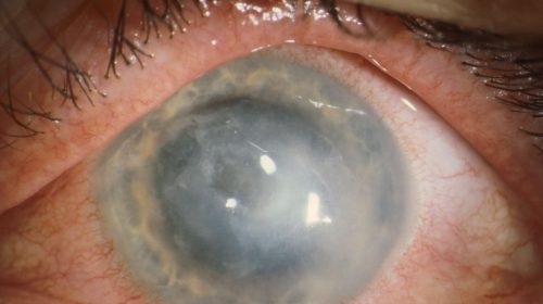 contact lenses, eye infections