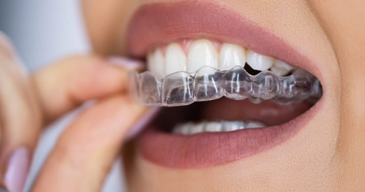 aligners