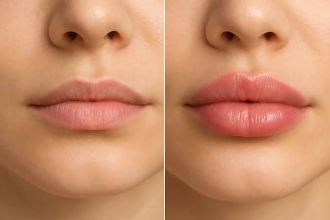 lip filler