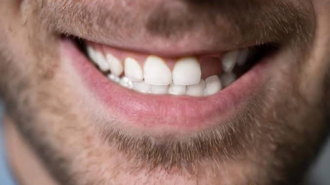 Changing Tooth Shape