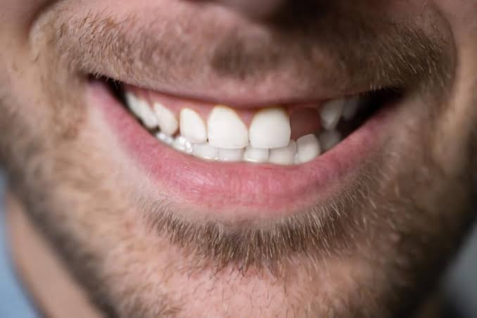 Changing Tooth Shape